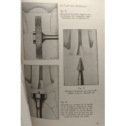 Technique de meulage et e la préparation des dents