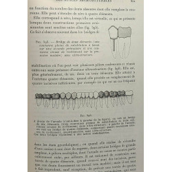 Prothèse dentaire conjointe --- Inlays Onlays couronnes et bridges...