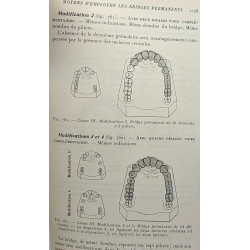 Prothèse dentaire conjointe --- Inlays Onlays couronnes et bridges...