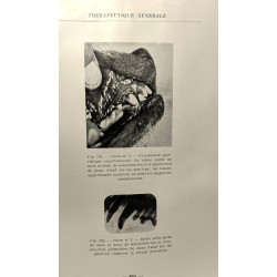 Les parodontoses pyorrhéiques ou pyorrhées alvéolaires (complexus...