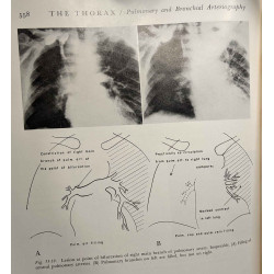 Abrams Angiography - VOLUME 1 et 2 - second edition - With 39...