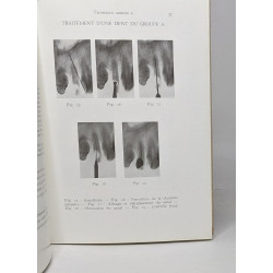 Traitement radiculaire par la méthode N2 - chirurgie rationnelle...