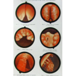 Traité d'urologie (tome premier et second 4e édition avec 627...