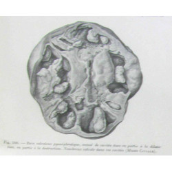 Traité d'urologie (tome premier et second 4e édition avec 627...