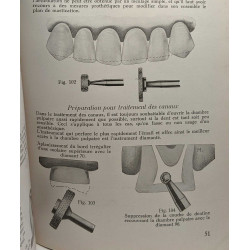 Technique de meulage et e la préparation des dents