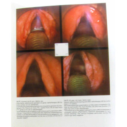 Larynx:Microlaryngoscopie et Histopathologie - Microlaryngoscopy...