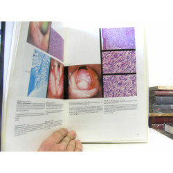 Larynx:Microlaryngoscopie et Histopathologie - Microlaryngoscopy...