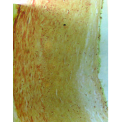 Athérosclérose humaine